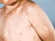 ADPH: Person with measles likely exposed other people during 2 stops in Alabama