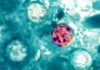 ADPH reports 28 cases of cyclosporiasis in Alabama as of July 20