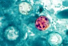 ADPH reports 28 cases of cyclosporiasis in Alabama as of July 20