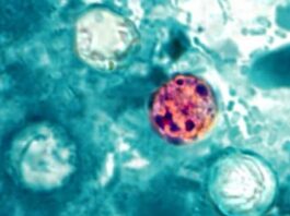 ADPH reports 28 cases of cyclosporiasis in Alabama as of July 20