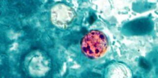 ADPH reports 28 cases of cyclosporiasis in Alabama as of July 20