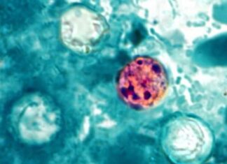 ADPH reports 28 cases of cyclosporiasis in Alabama as of July 20