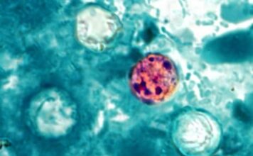 ADPH reports 28 cases of cyclosporiasis in Alabama as of July 20