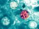 ADPH reports 28 cases of cyclosporiasis in Alabama as of July 20