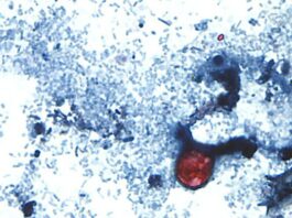 Cyclospora cases emphasize the need for food safety Â