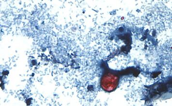Cyclospora cases emphasize the need for food safety Â